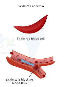 SickleCare Project Launch